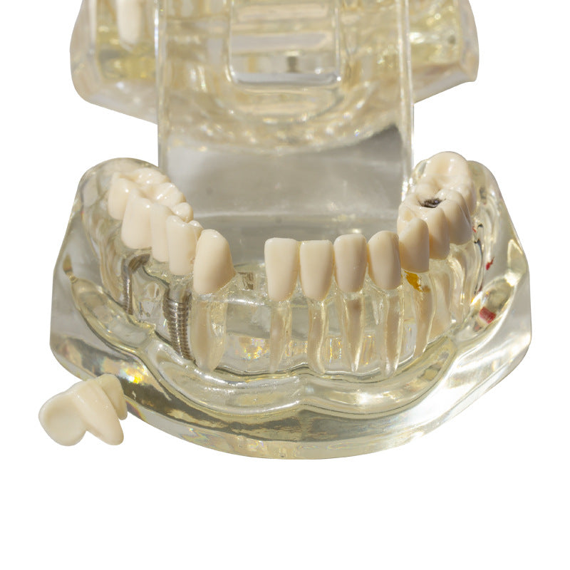 Dental implant restoration model oral teaching model