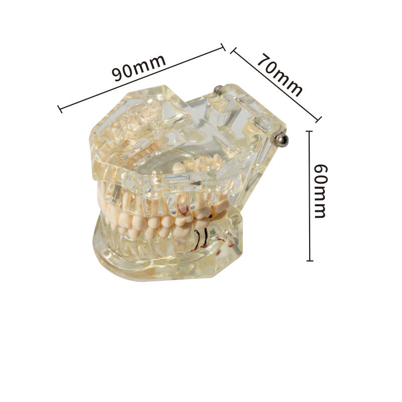 Dental implant restoration model oral teaching model