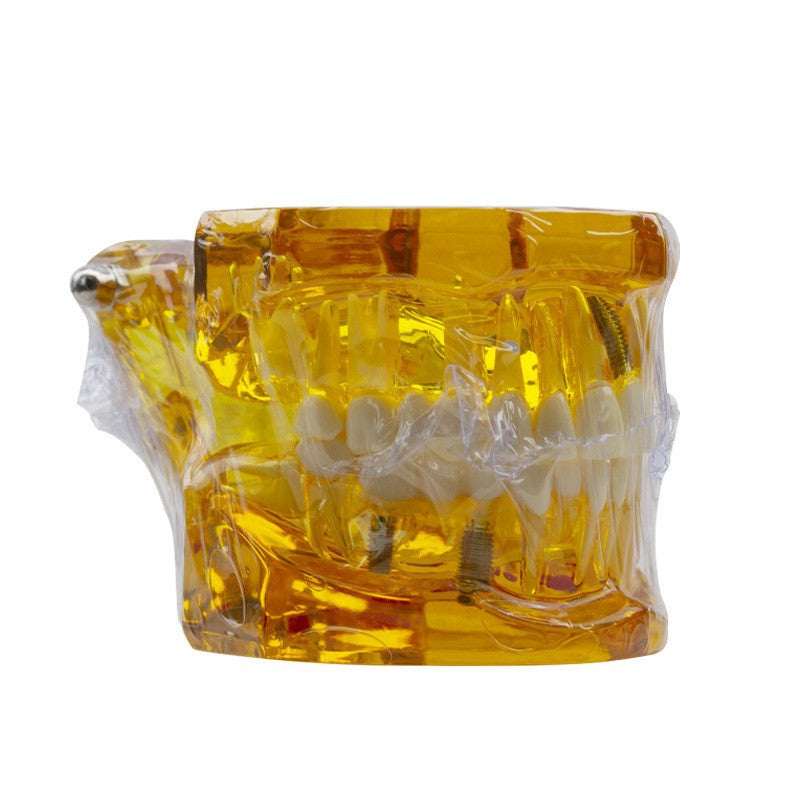 Dental implant restoration model oral teaching model