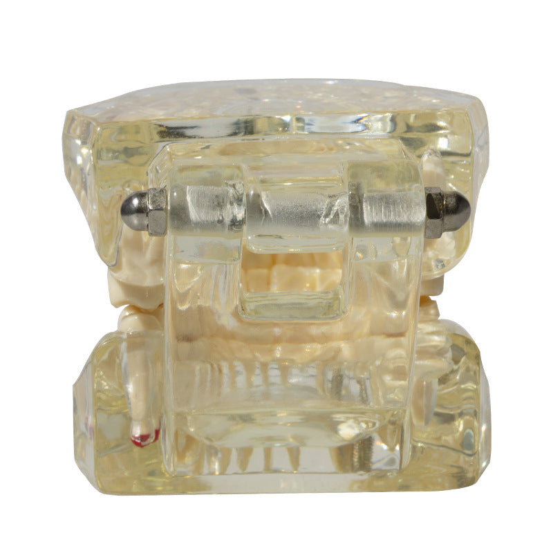 Dental implant restoration model oral teaching model