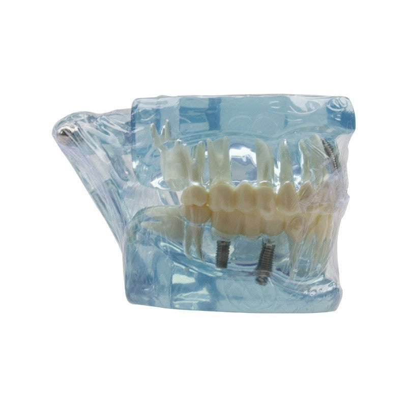 Dental implant restoration model oral teaching model