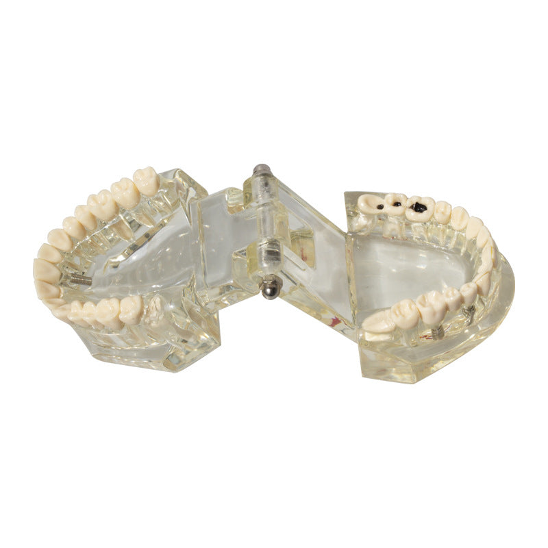 Dental implant restoration model oral teaching model