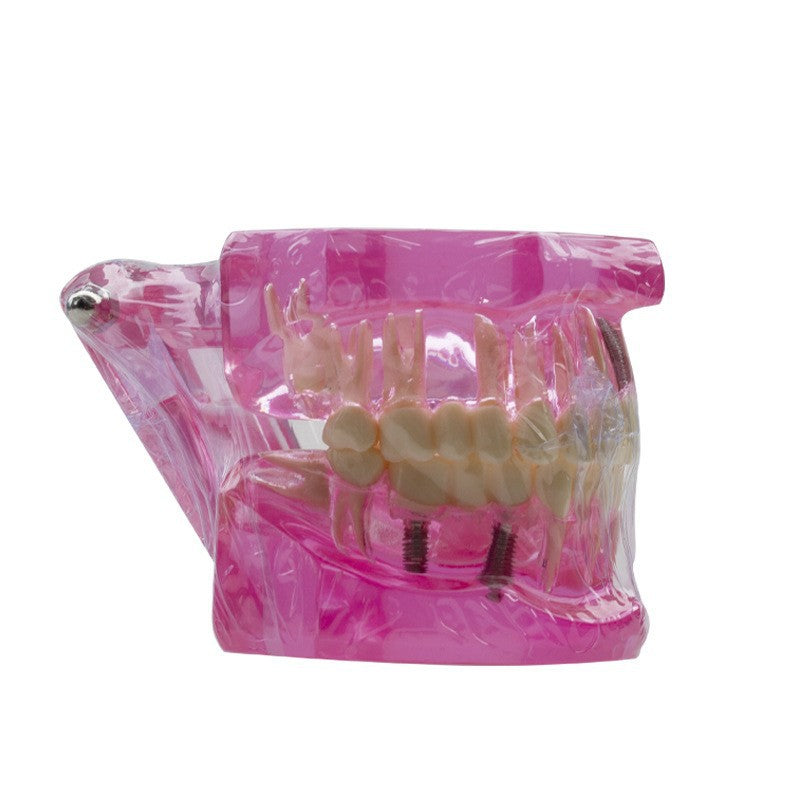 Dental implant restoration model oral teaching model