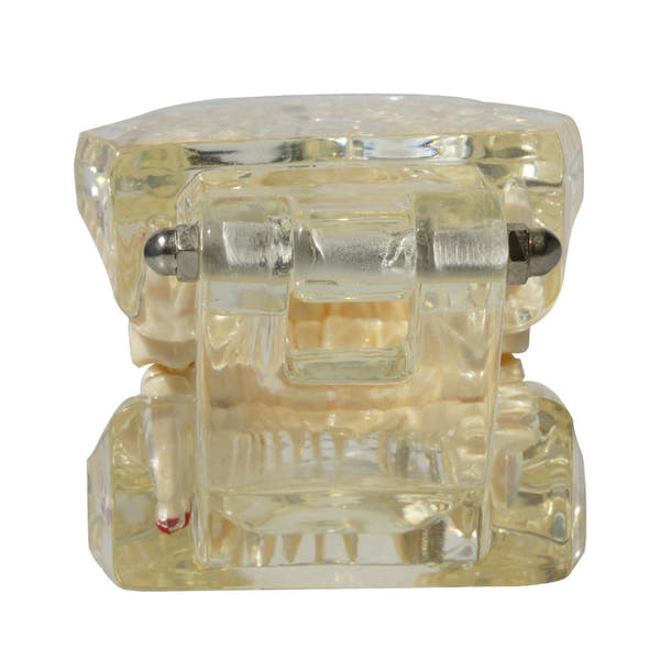 Dental implant restoration model oral teaching model