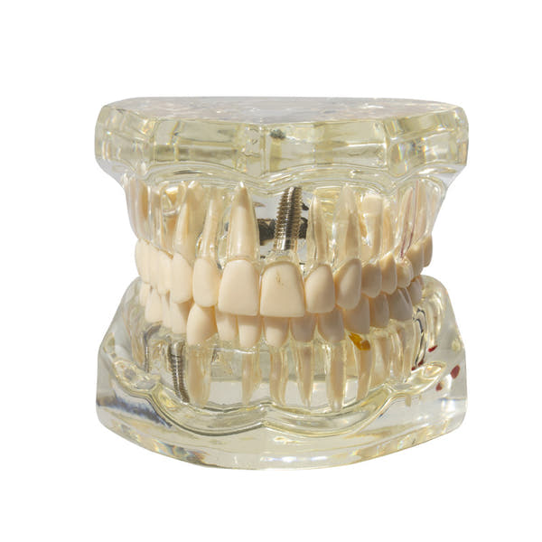 Dental implant restoration model oral teaching model