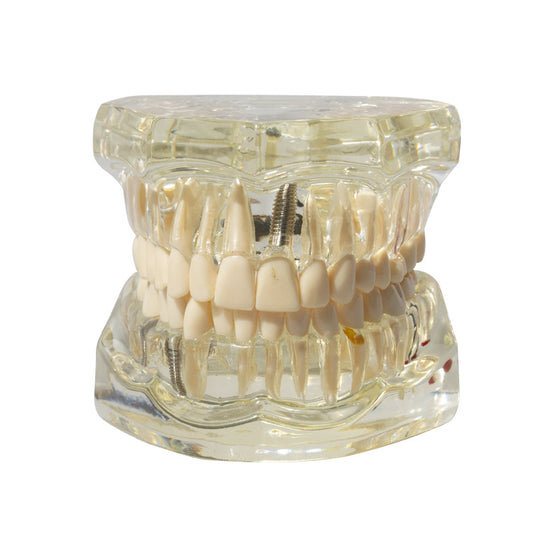 Dental implant restoration model oral teaching model